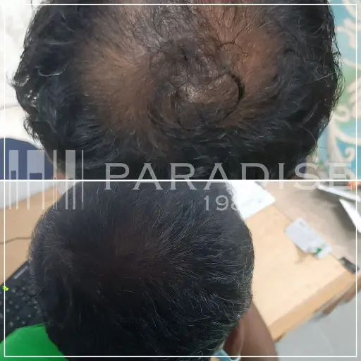 Before and after Neo Hair Lotion – natural regrowth on thinning scalp.