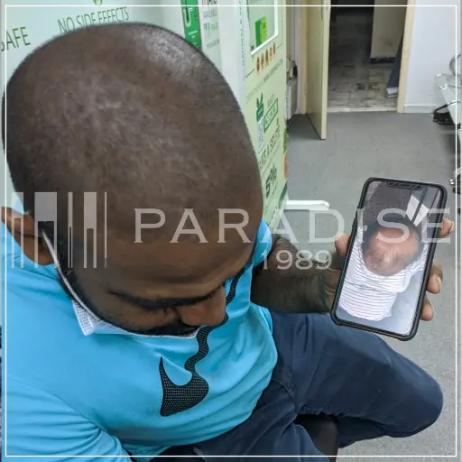 Hair growth results with Neo Hair Lotion – thicker hairline density.