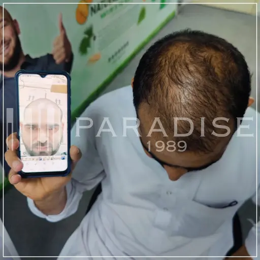 Hair restoration with Neo Hair Lotion – fuller and healthier hair.