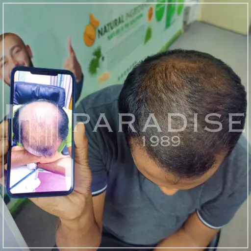 Neo Hair Lotion anti-hair loss treatment – reduced thinning and stronger scalp.