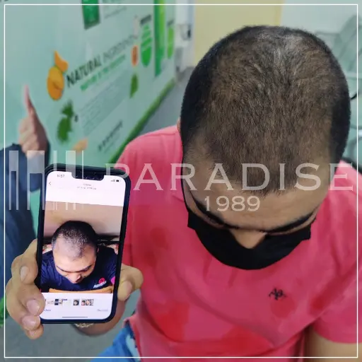 Neo Hair Lotion success story – thicker, denser hair growth.