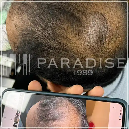 Neo Hair Lotion treatment – stronger strands and reduced hair fall