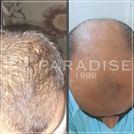 Hair regrowth solution – Neo Hair Lotion strengthens roots and prevents loss.