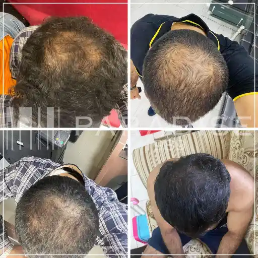 Neo Hair Lotion results – restored shine and healthy volume.